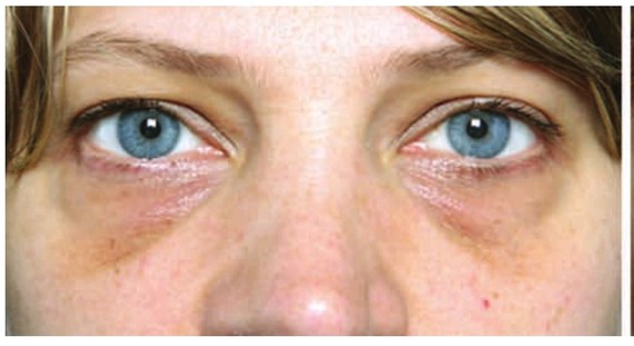 黑眼圈可分为色素型,血管型,结构型还有混合型,其中纳米脂肪