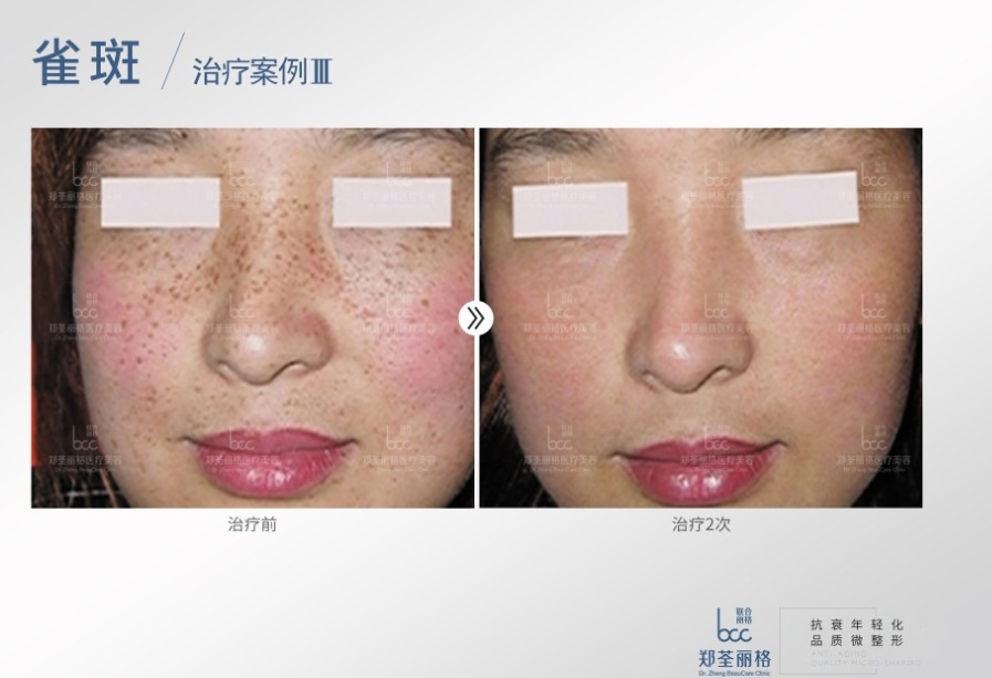 最近脸上长了很多斑 怎么判断脸上是什 新氧美容整形