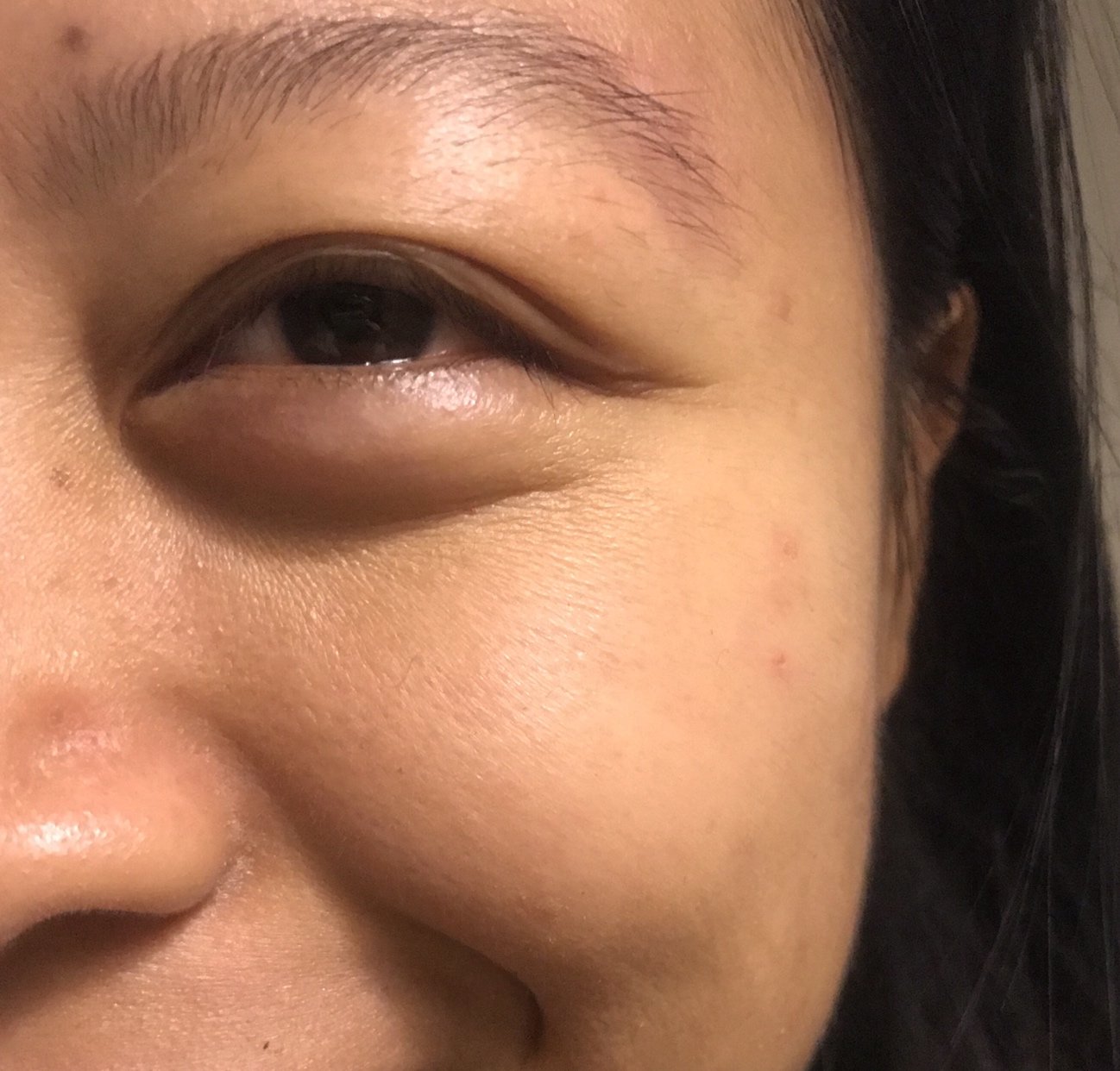 眼部动态纹和静态细纹和泪沟应该怎么处理