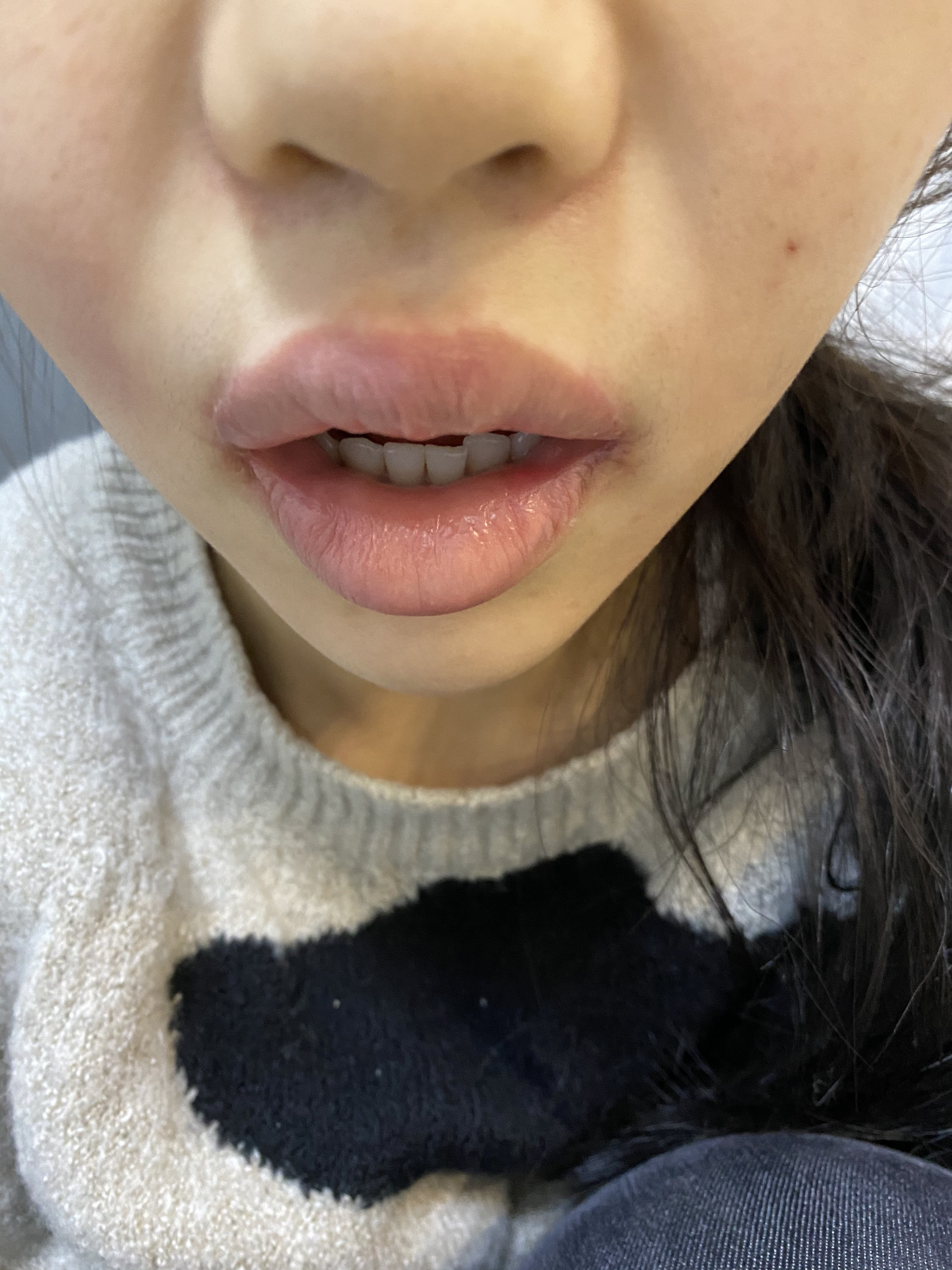 嘴角上扬和m唇两个月疤痕严重