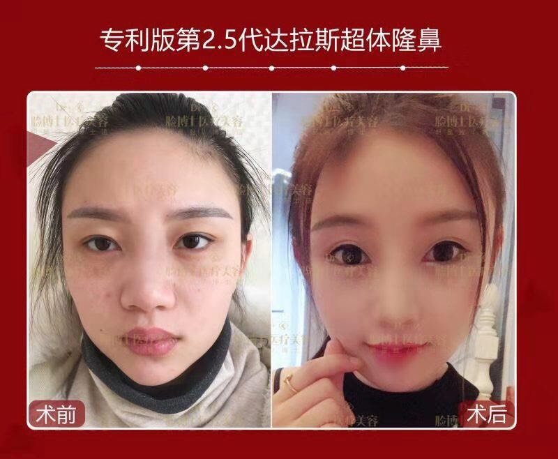 为什么有的人做完鼻部多项术后会出现呼吸 新氧美容整形