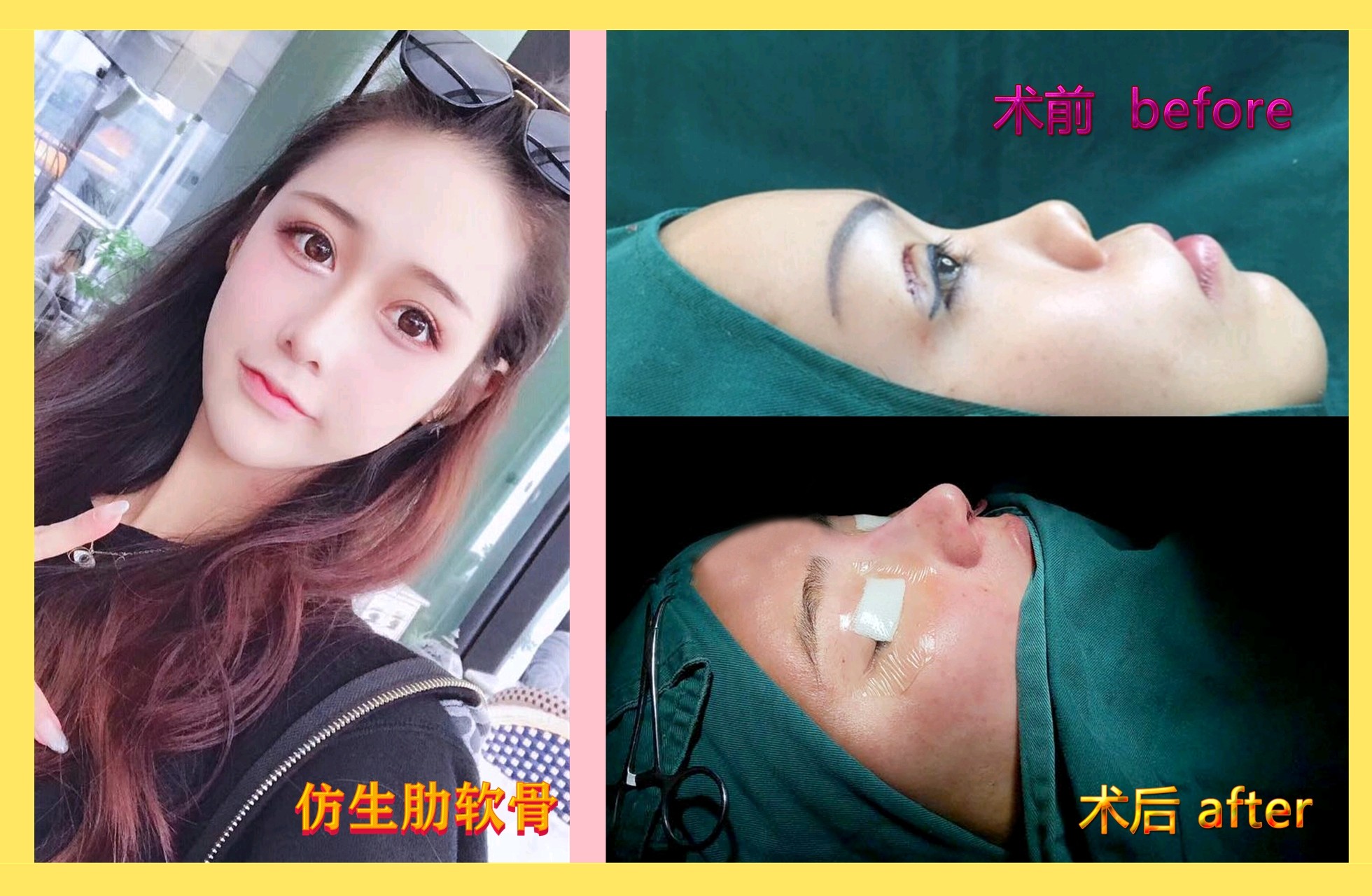 谁来挽救我的鼻子 新氧美容整形