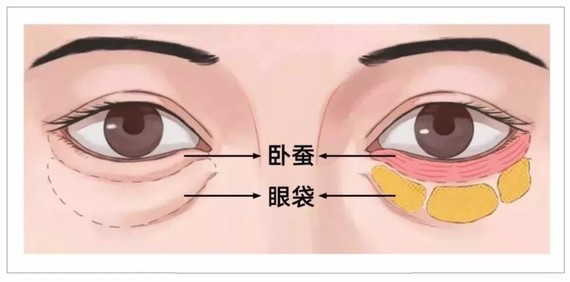 一笑眼睛就肿肿的是眼袋吗 分不清眼袋 新氧美容整形