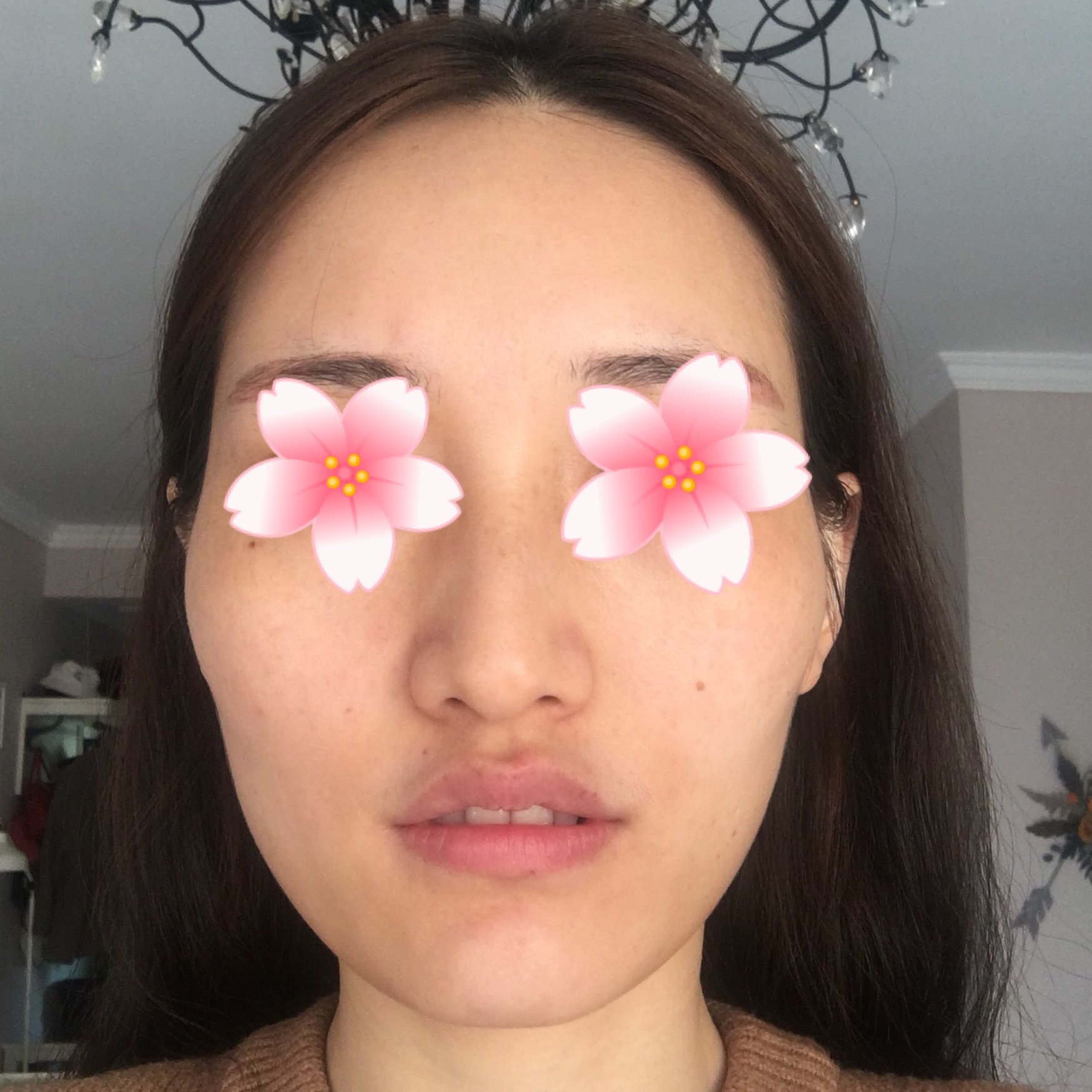 颧弓外扩 太阳穴凹陷 大小脸 我的脸型是_新氧-专业医美服务平台