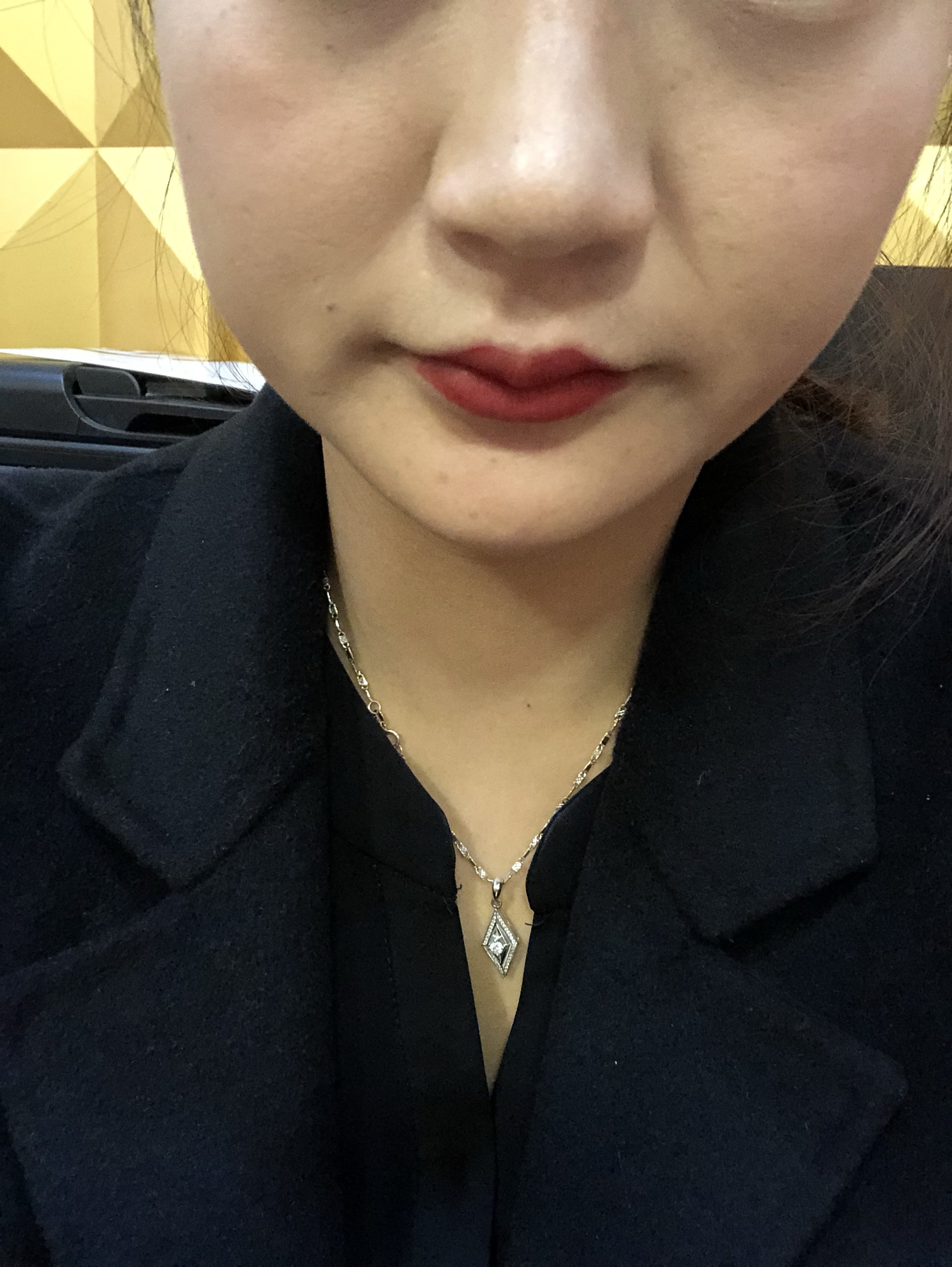 28岁法令纹深我需要填充法令纹还是鼻基底还是苹果肌