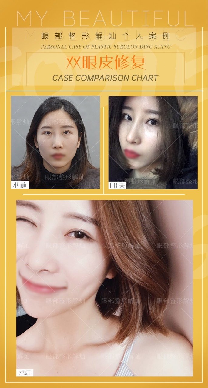 什么样的双眼皮需要修复 新氧美容整形