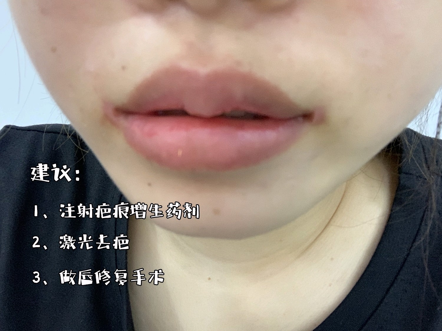 做嘴角上扬留下的疤痕五个月了还能掉 新氧美容整形