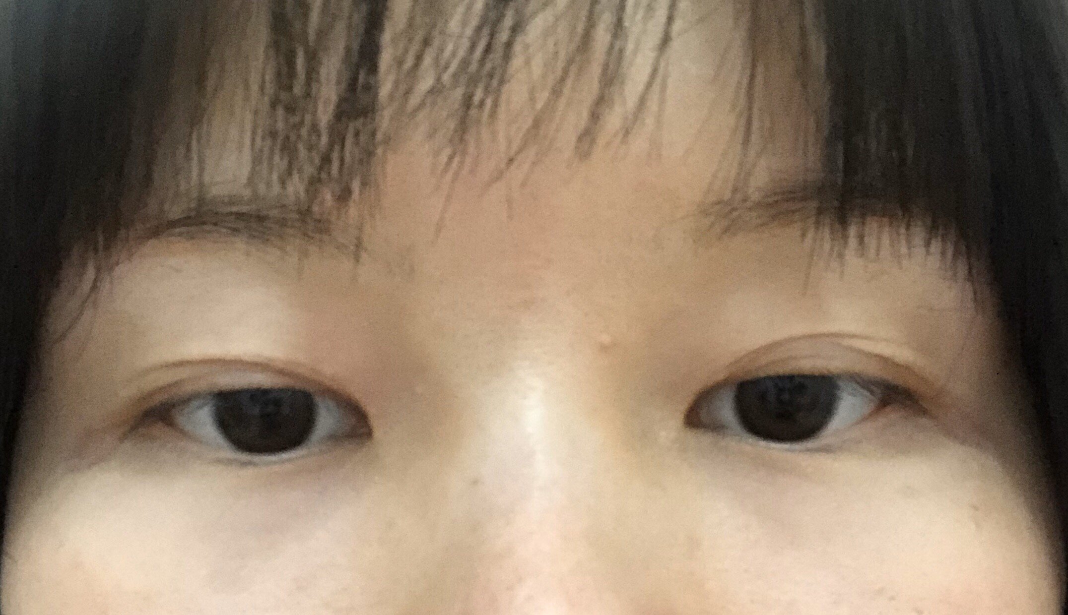 双眼皮修复 双眼皮做了三年半了,先是三点,大小眼明显后面做修复惹行