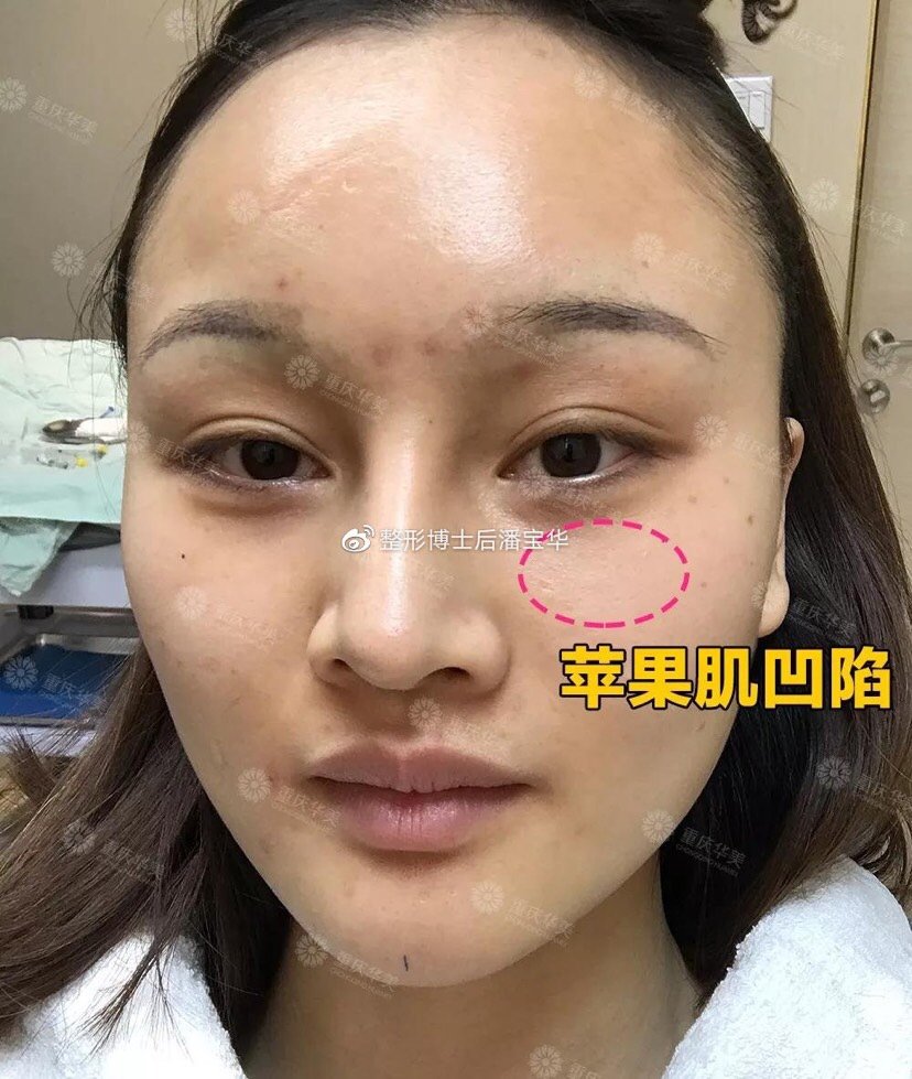 玻尿酸填充苹果肌会让脸下垂吗