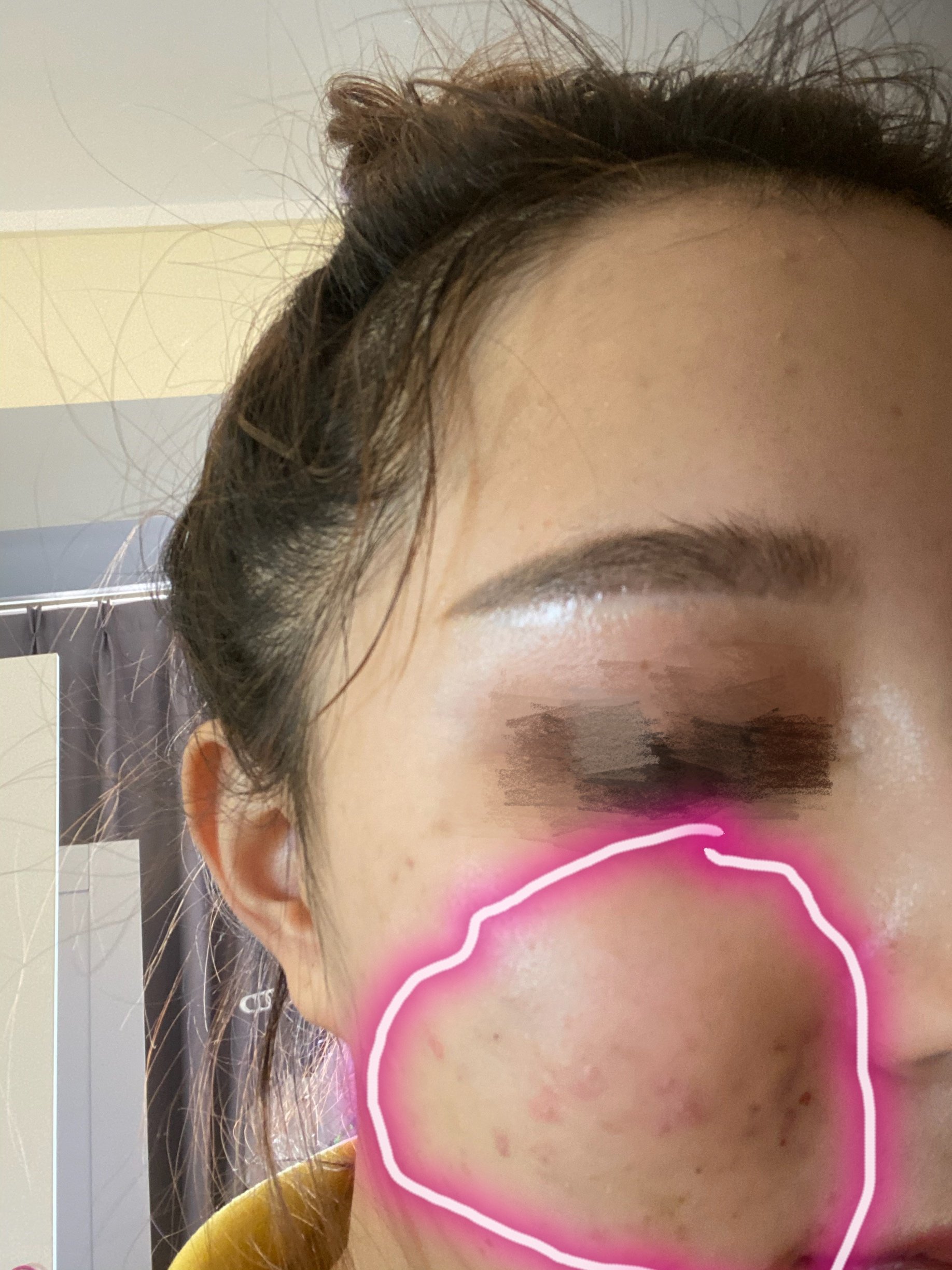 线雕后一个多月了 出现了硬鼓 多出一块肉 有办法解决吗