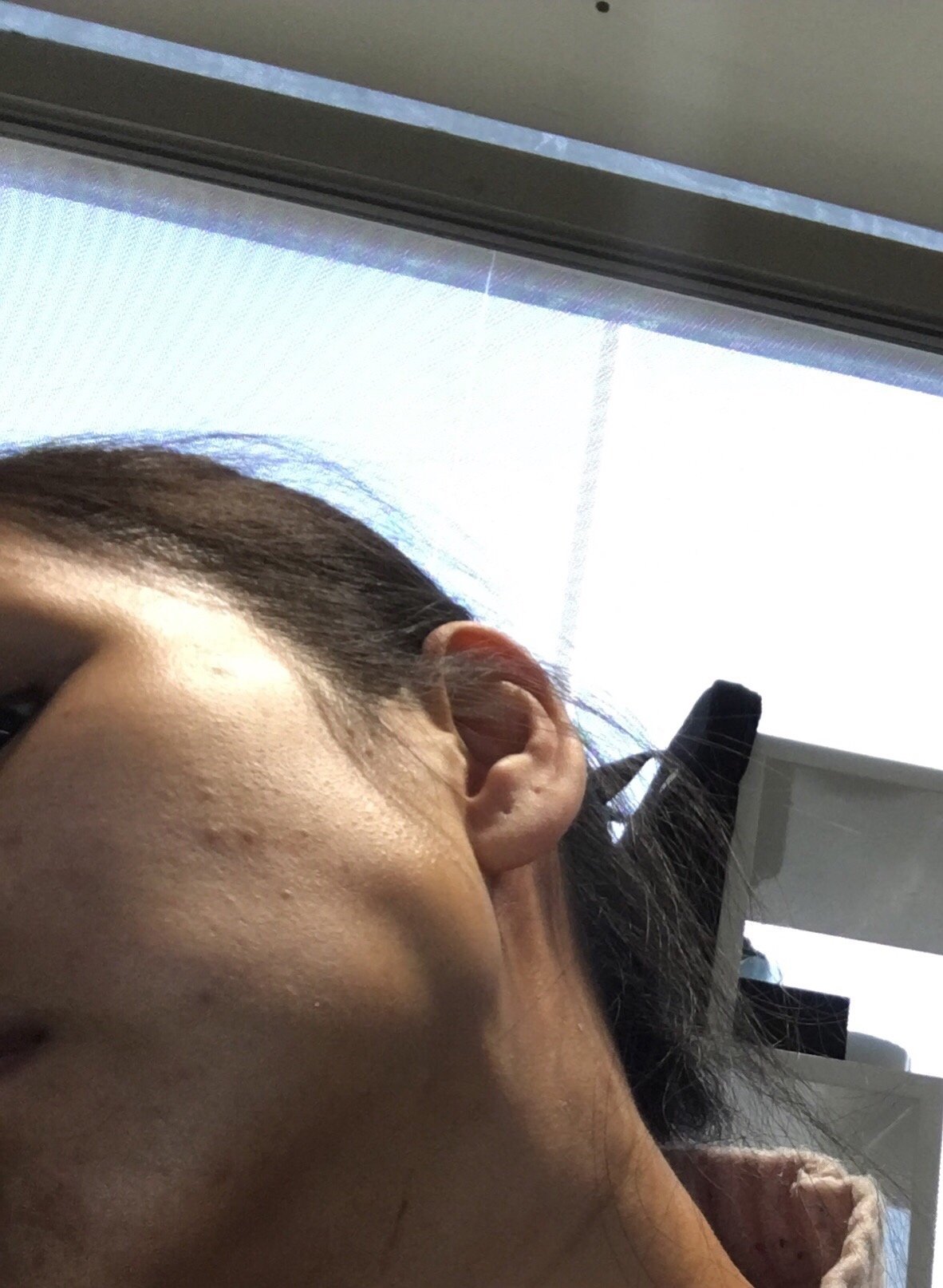 面部吸脂失败,出现大面积凹陷已经1个班_新氧-专业医美服务平台