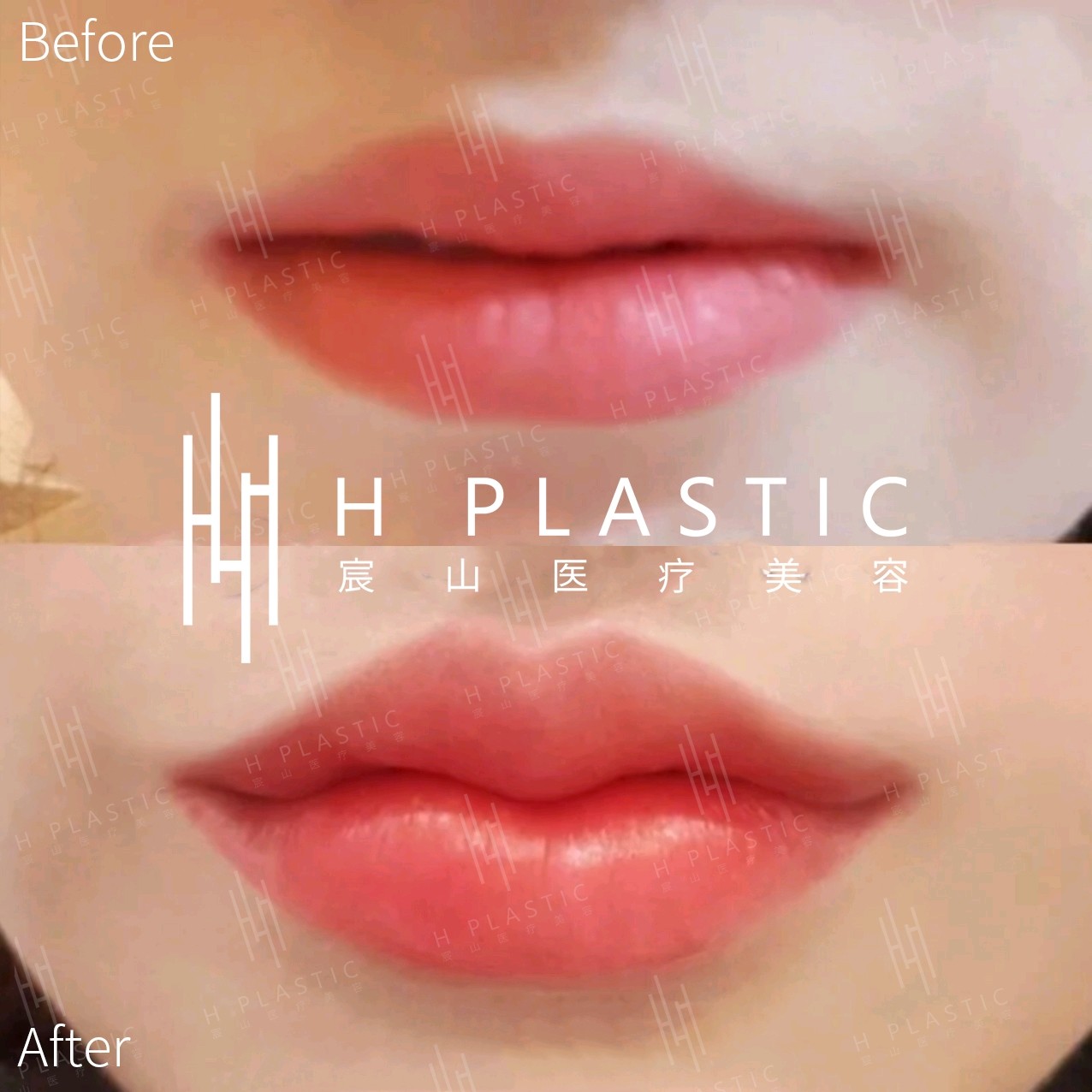 首页 此页面仅支持预览 Avatar 林春华 131篇日记 花瓣唇辣眼睛 唇部美学应该是这样打开的嘴唇形状形似花瓣 又称之为花瓣唇 听上去很美 但是不少人辣眼睛 这样的嘴唇真的好看吗 大众审美中真的接受不少了这样的嘴唇 嘴巴是五官中最性感的部位