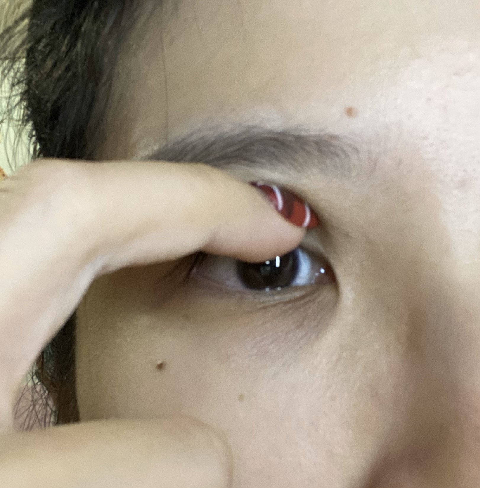我这个眼睛咋整是不是要切内眦赘皮