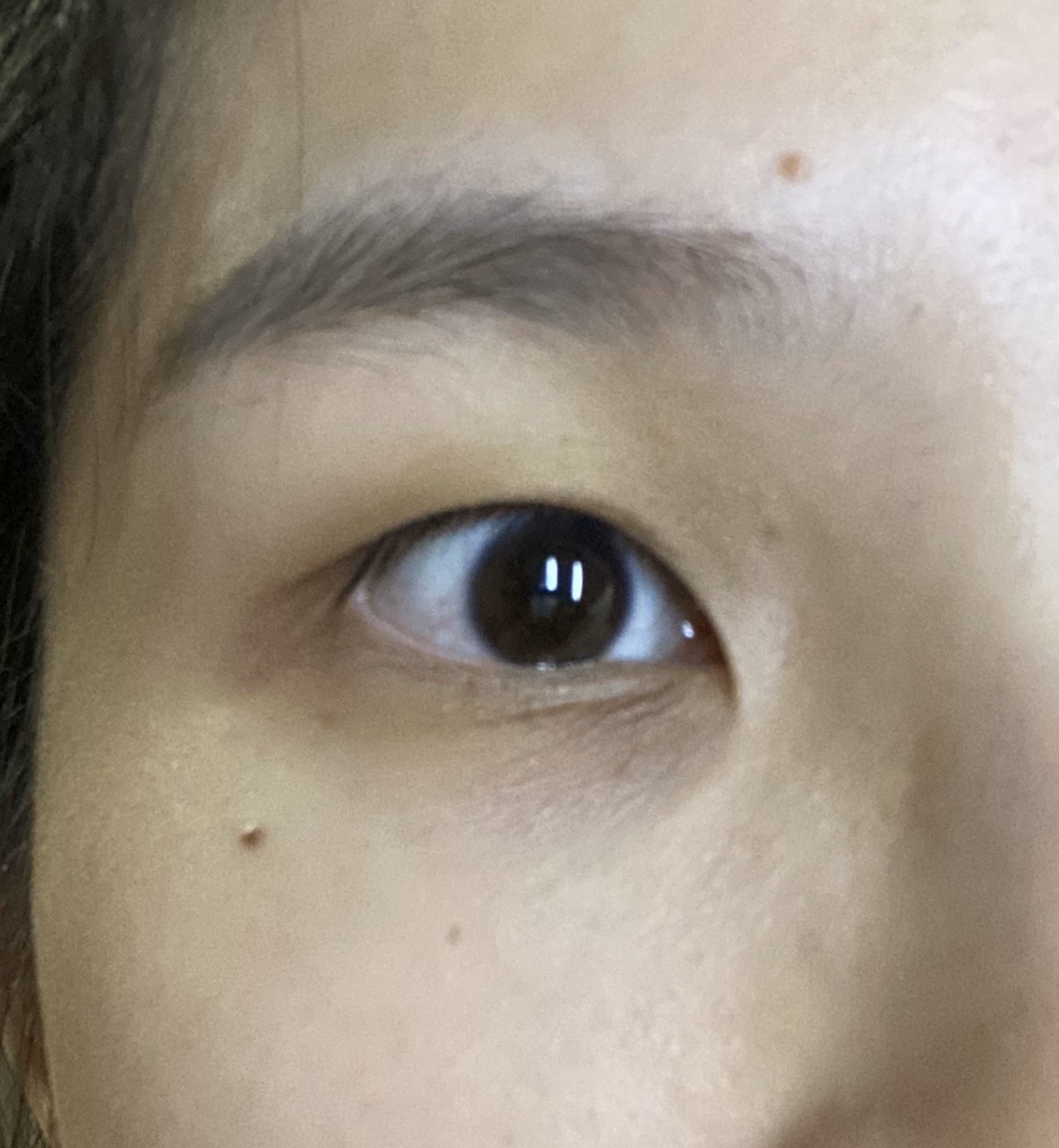 我这个眼睛咋整是不是要切内眦赘皮