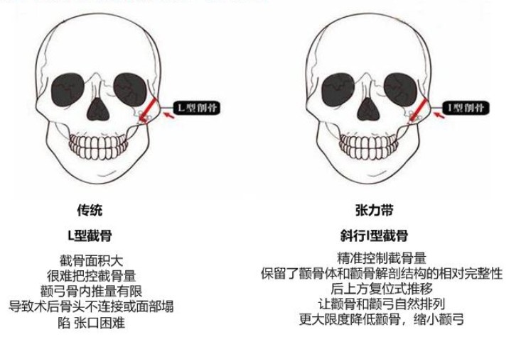 脸部颧骨在哪里图片图片