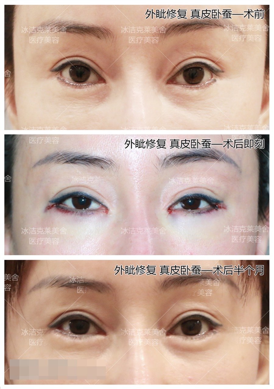 有卧蚕的人笑容都特别甜美,非常有魅力,让人愿意亲近_圈子-新氧美容