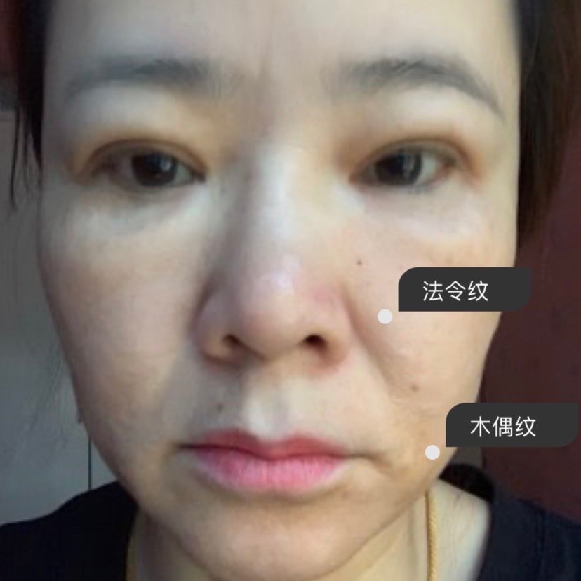 整体看过来下垂问题还是比较严重的,口周颊脂垫,苹果肌颊脂垫都在下垂