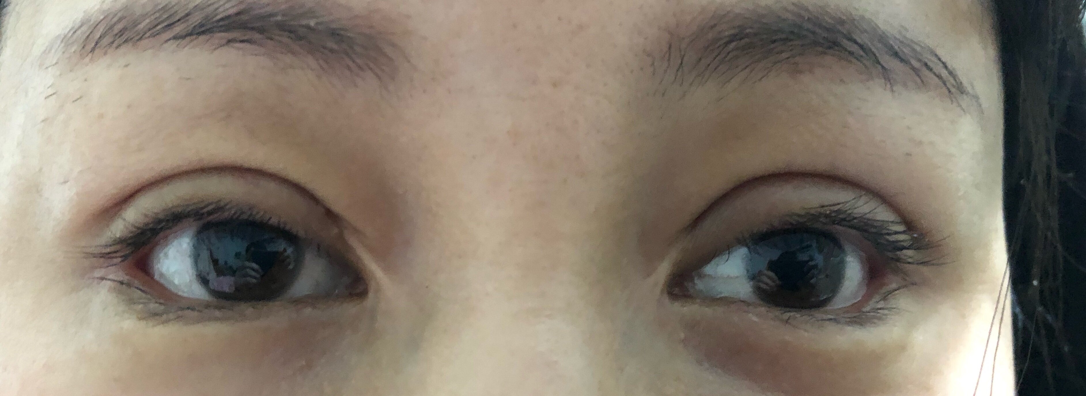 开内眼角一年多了疤痕增生严重医生手法问题开的眼角比较大有白色疤痕