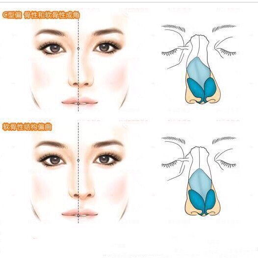 鼻子歪的原因 新氧 专业医美服务平台
