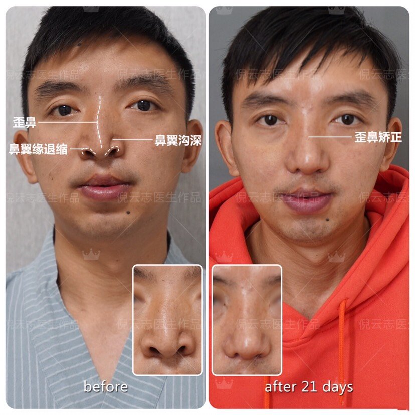 鼻子歪的原因 新氧 专业医美服务平台