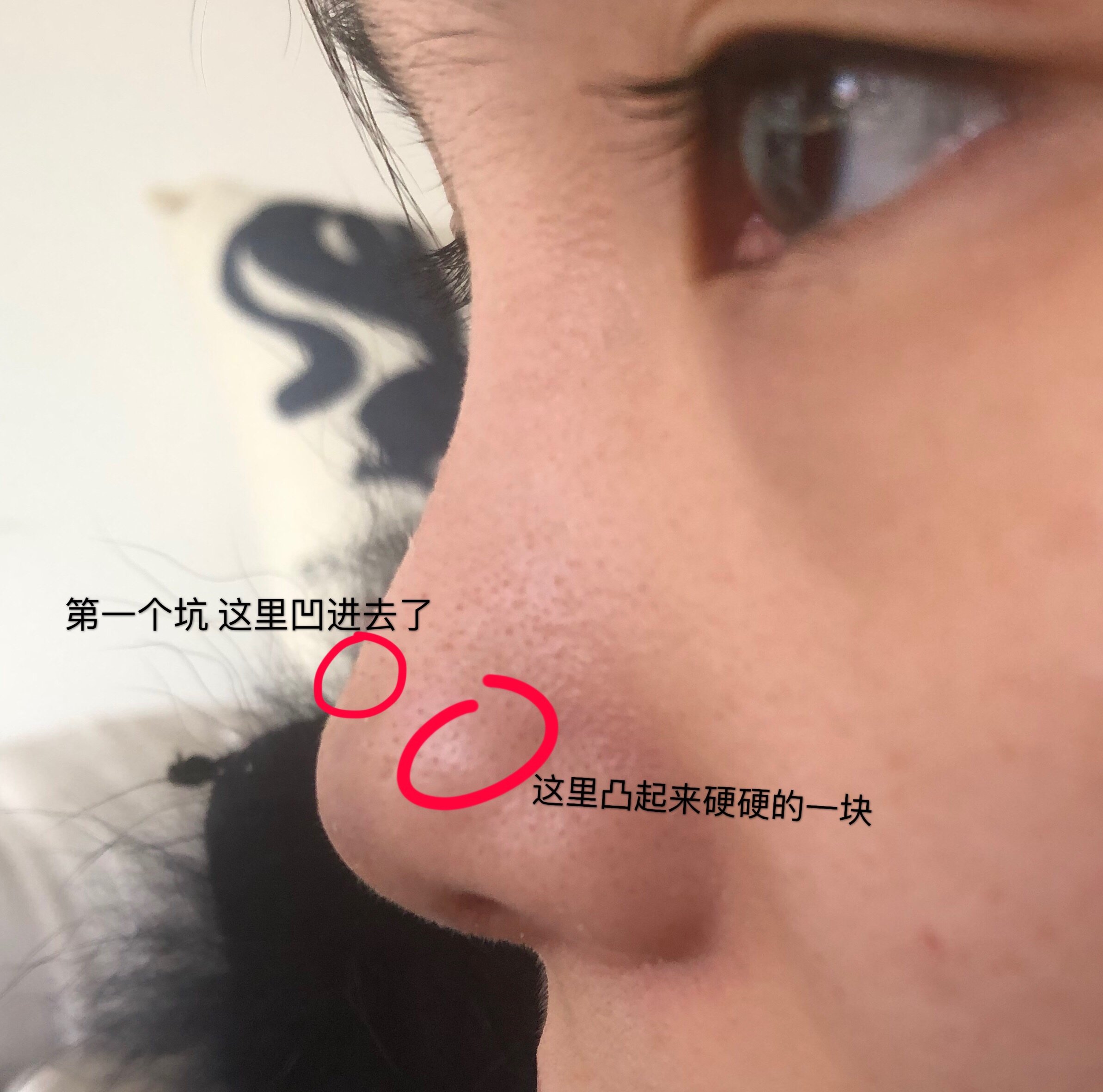 鼻头膨体感染取出后鼻头留坑了侧面凹陷颜色发紫后期会恢复么