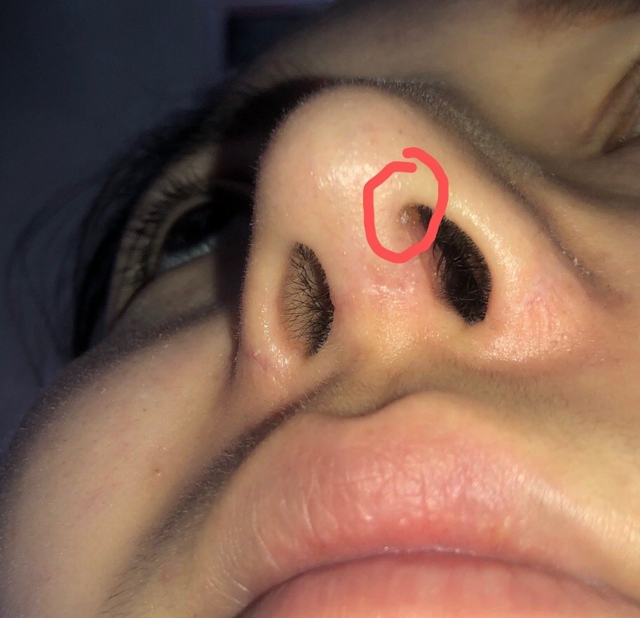 肋骨鼻四个多月突然左鼻孔上侧痛然后开始结黄痂是怎么回事是要假体外