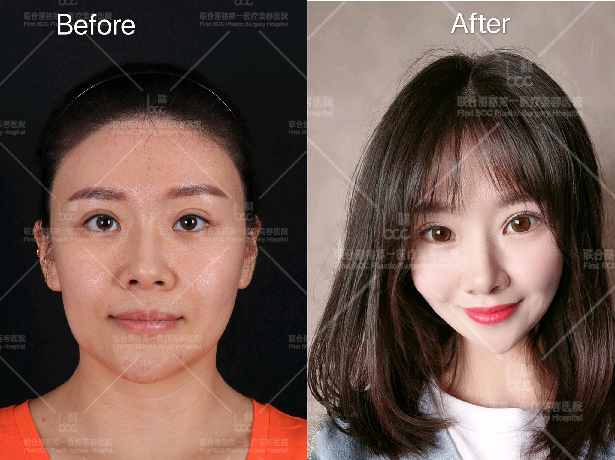 埋线提升可以改善法令纹吗 效果好不好 新氧美容整形