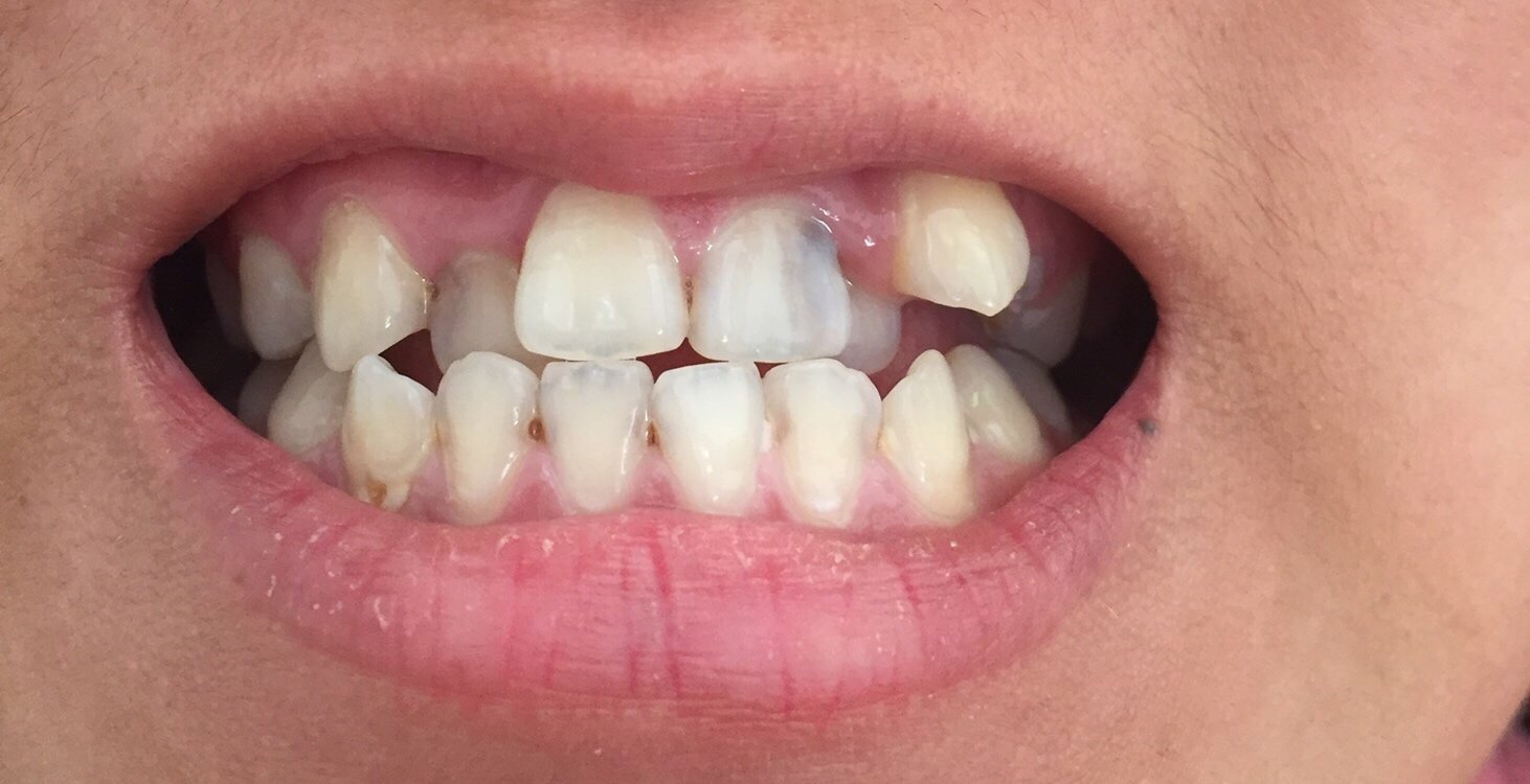 又那么不整齐又那么多蛀牙这样的牙齿还有救吗