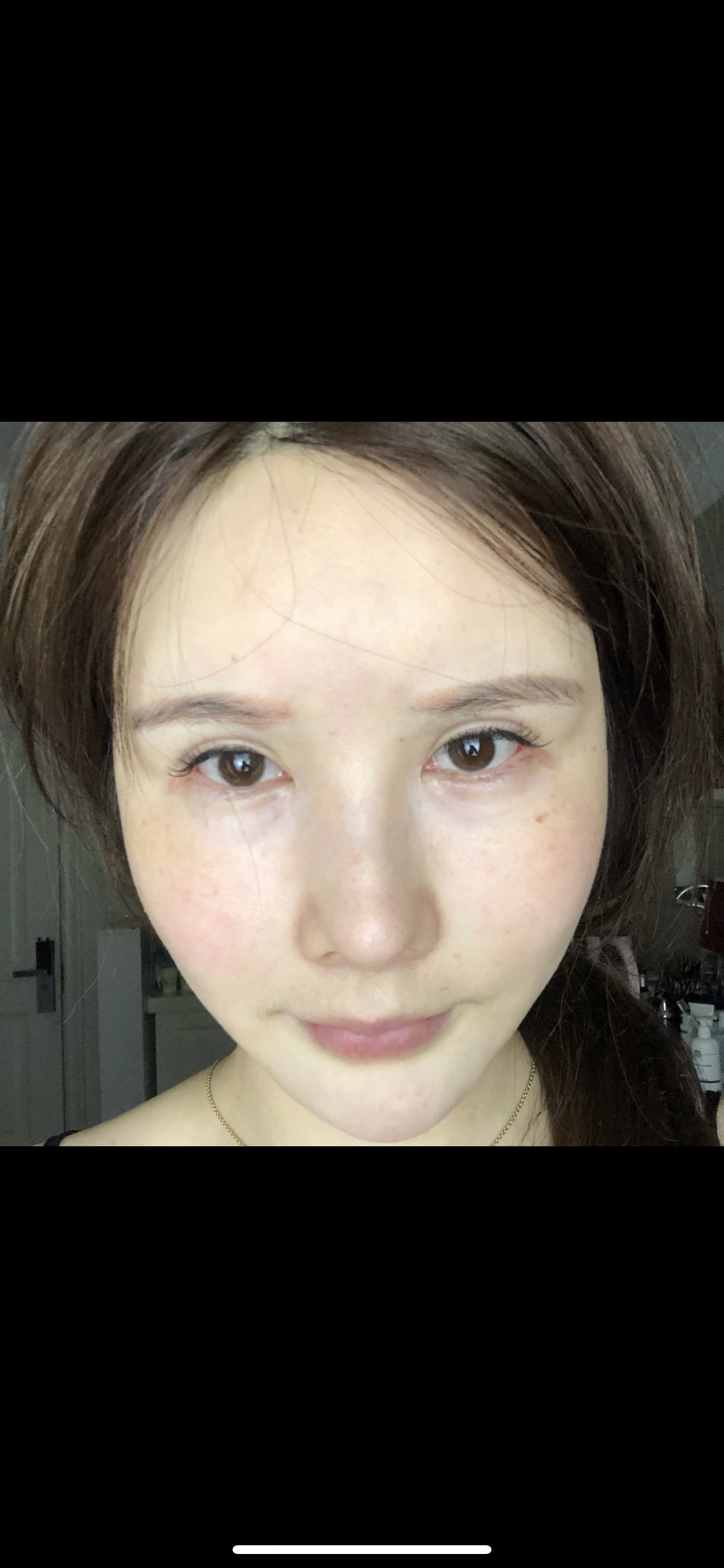 眼睛做了三次做了大欧式双眼皮疤痕严重肉条明显眼窝凹陷我善于表达