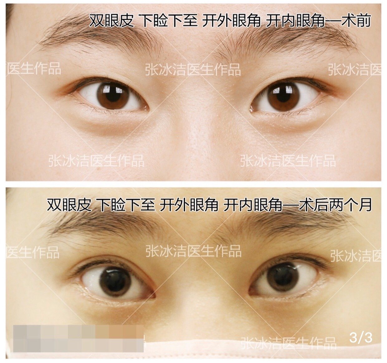 开外眼角和眼睑下至的区别,手术前一定要弄明白的事!