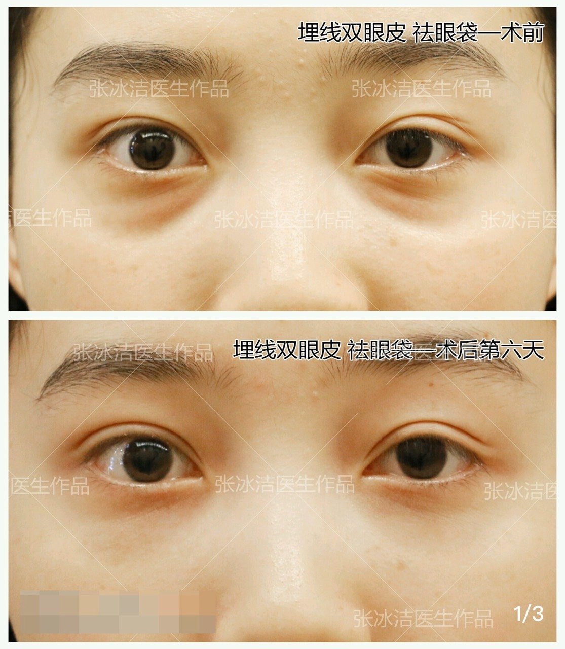 眼袋手术做失败了怎么修复 能修复好吗造成眼袋失败的 圈子 新氧美容整形