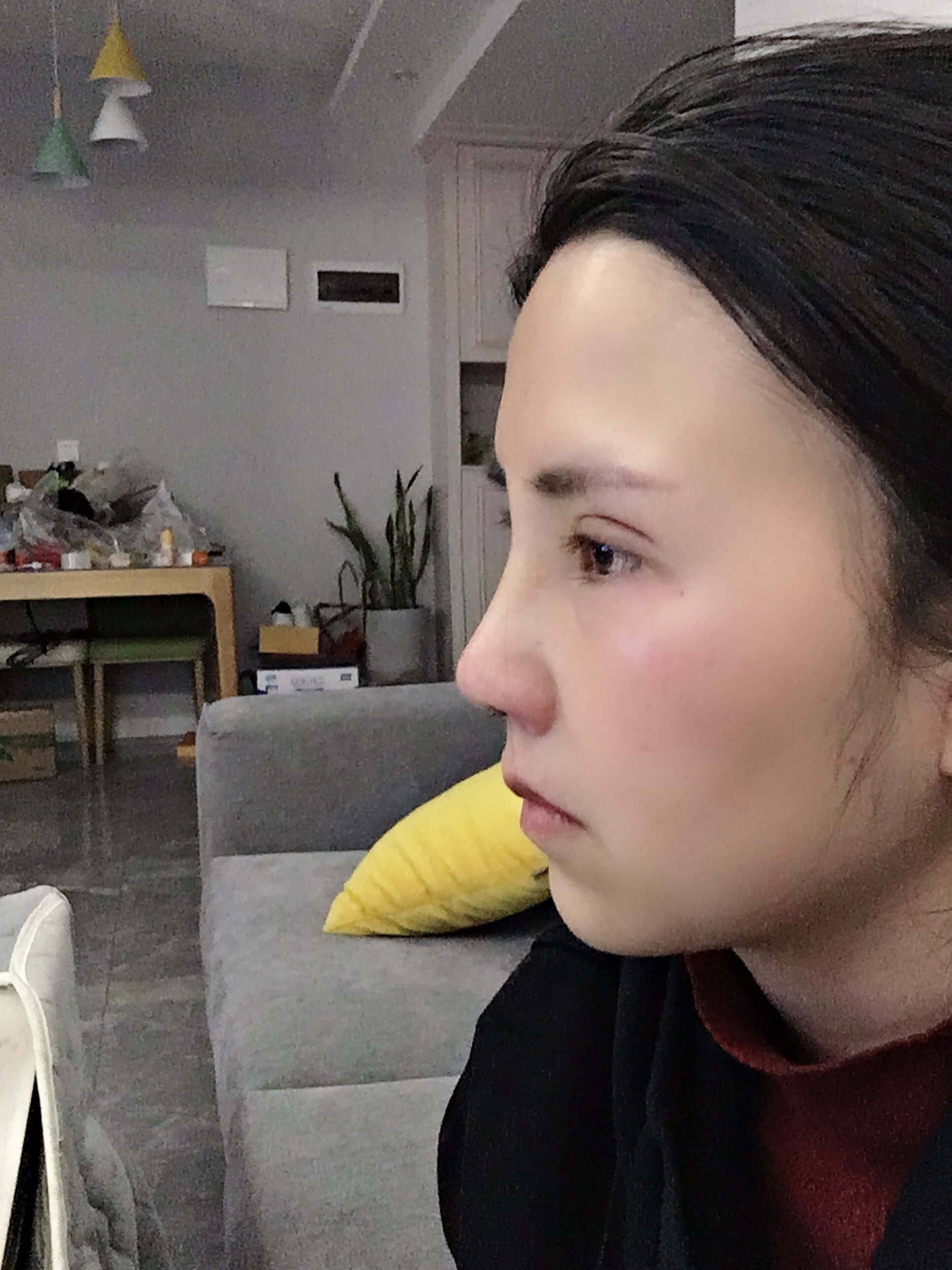 膨体加耳软骨隆鼻第八天感觉山根太高了手摸眉心之间鼻梁也有假体正常