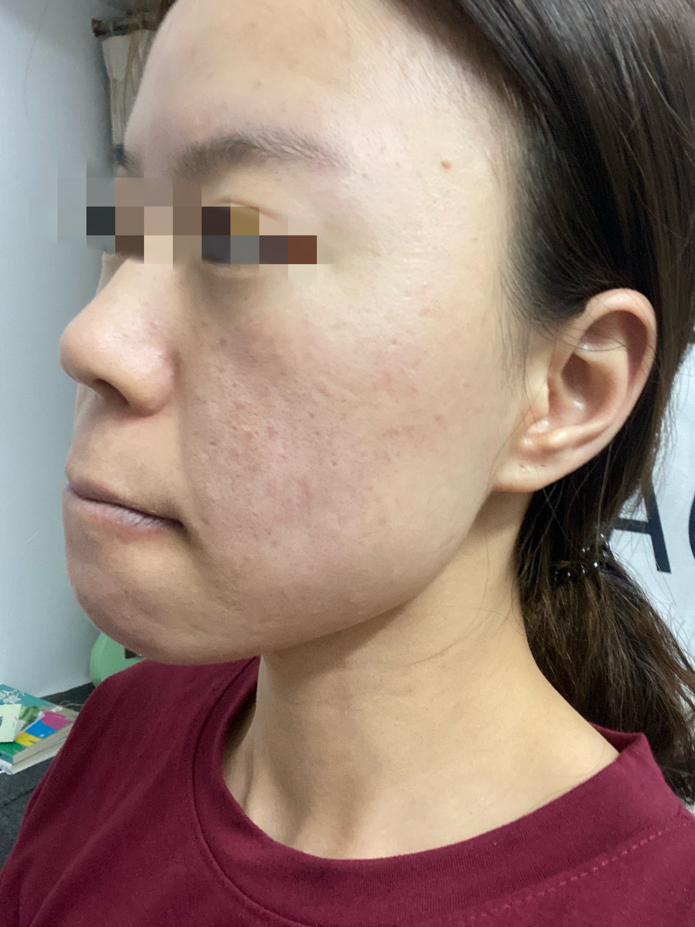 毛孔粗大和痘印做什么项目好