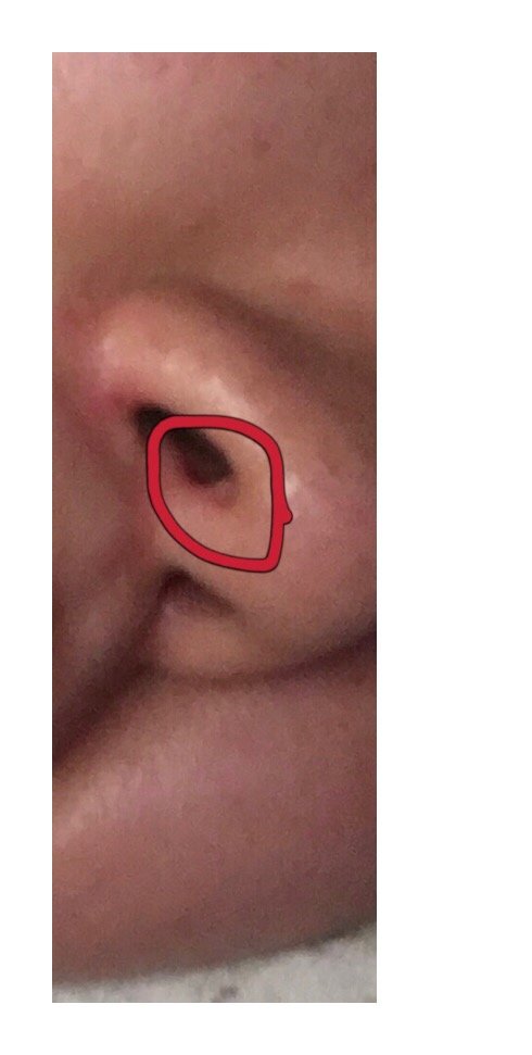 做了耳软骨垫鼻尖一年了发现鼻孔内侧有一个白点突起就像痘痘一样的