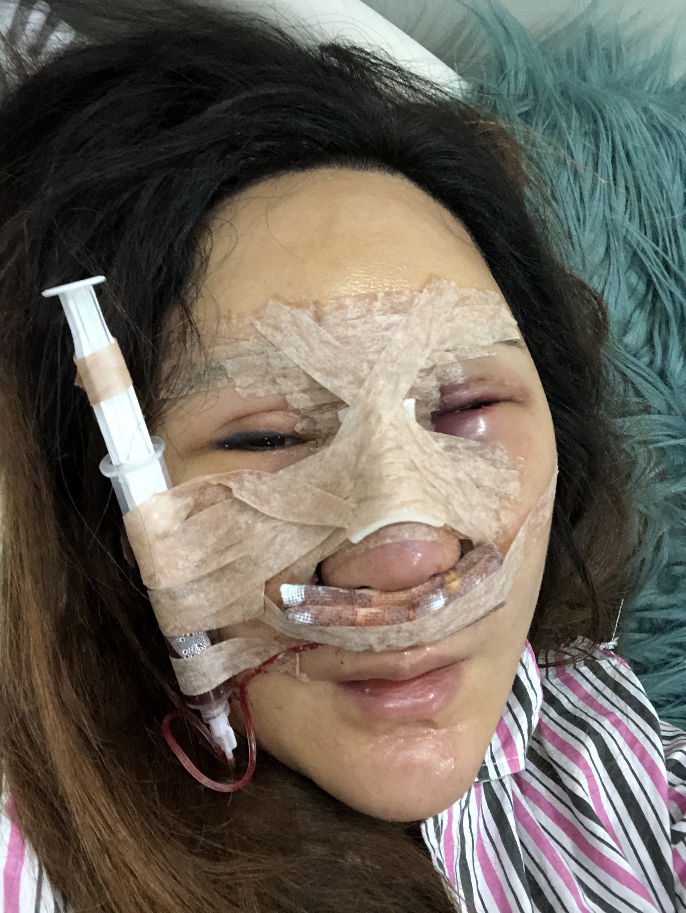 鼻修复,肋骨钙化用不了,用的超体耳软骨 第一天就