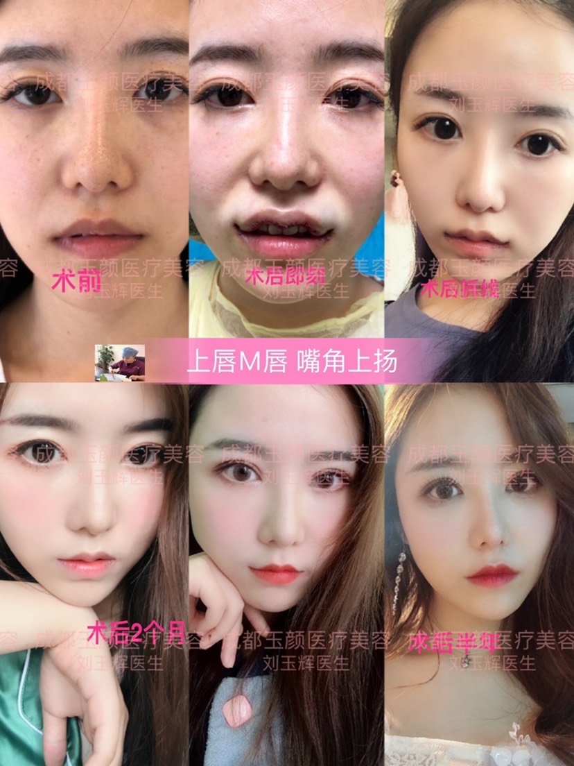 这样的嘴唇应该做什么项目