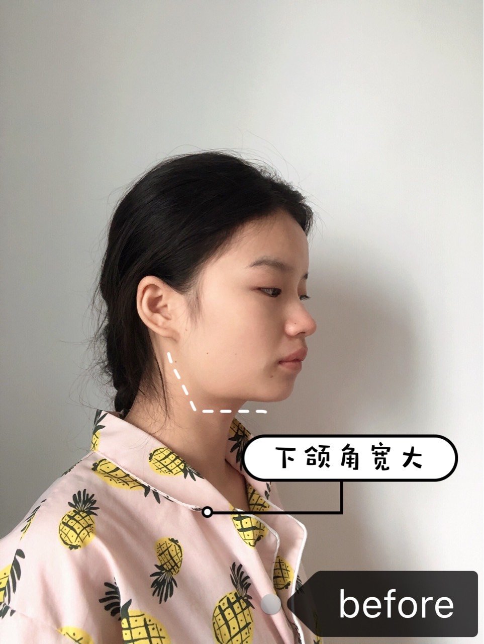 看完这个就知道下颌角对颜值的影响力有多大了