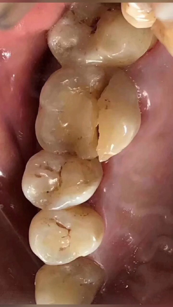 根管治疗(杀神经)后的牙齿没有血液流通,没有营养供_圈子-新氧美容