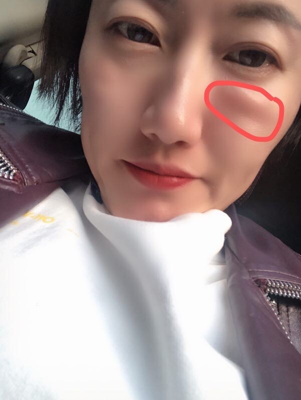 之前玻尿酸填充完泪沟淤青了之后几个月都是肿的状态