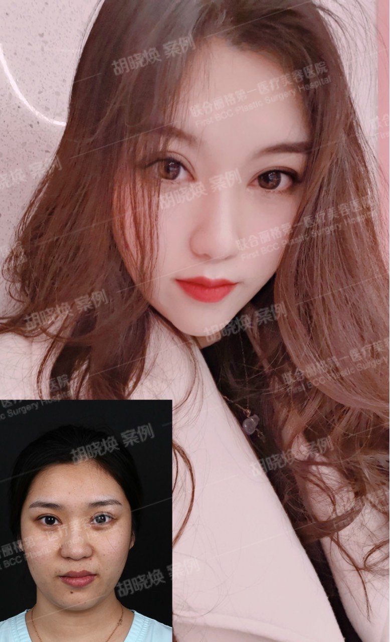 瘦脸针的效果好吗_新氧美容整形