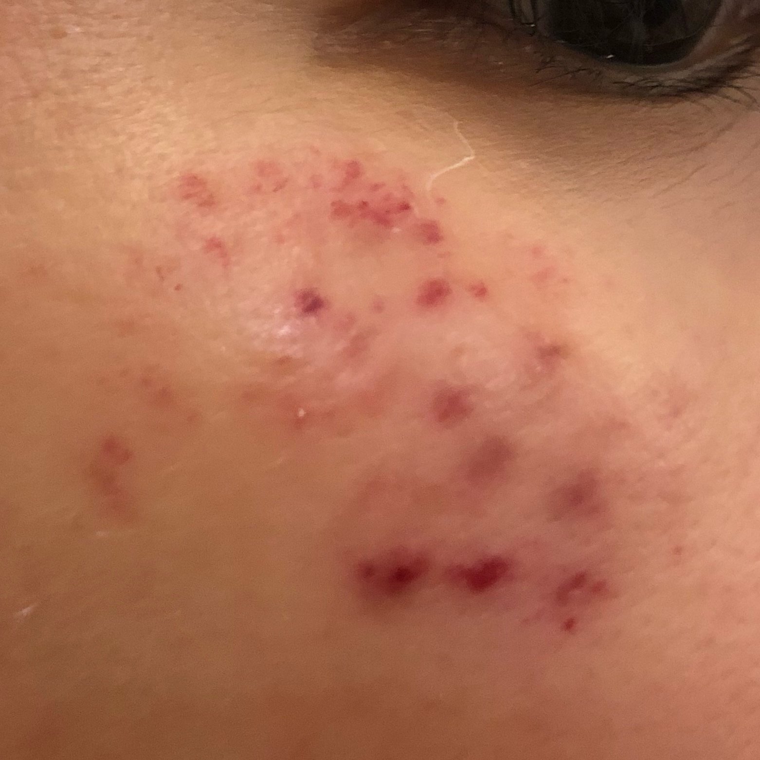 超皮秒后出血了怎么办很害怕 新氧 专业医美服务平台