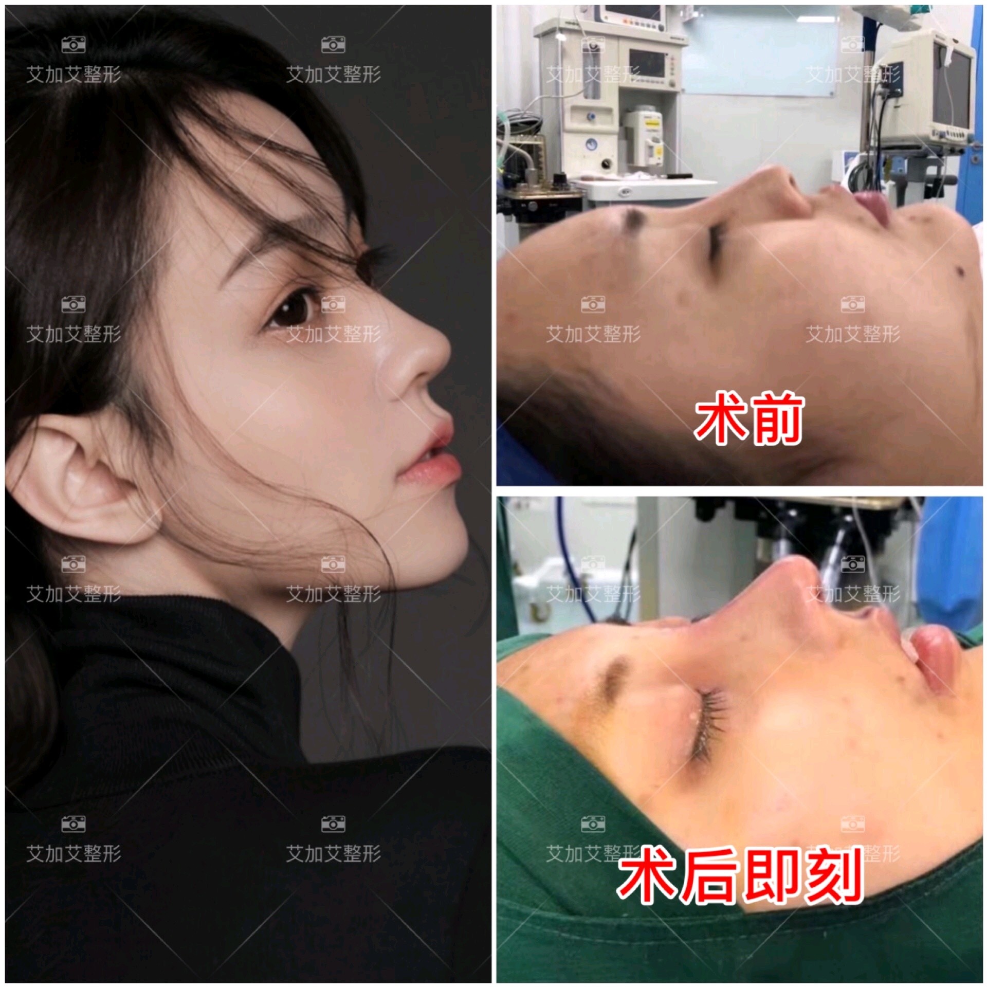 肋骨隆鼻术后即刻