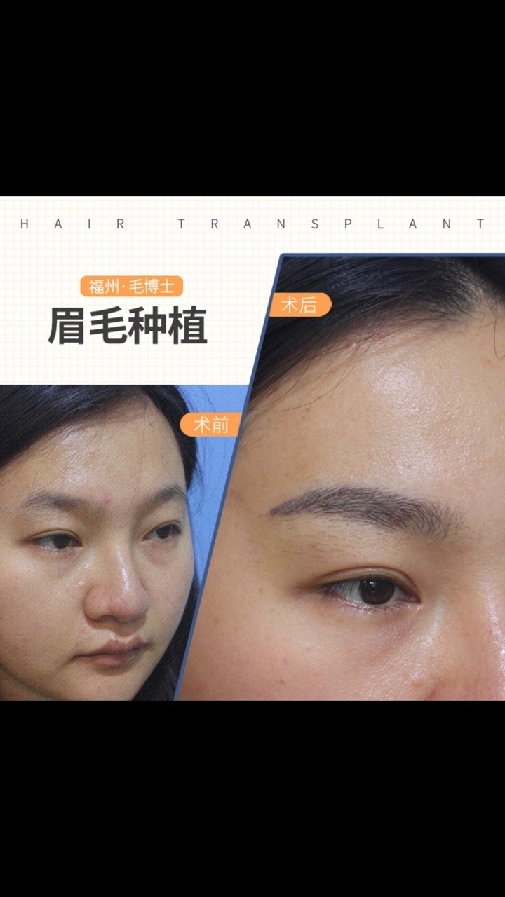 刚种植几天的眉毛不满意眉型排列顺序可以拔掉修复后重新种植吗急急急