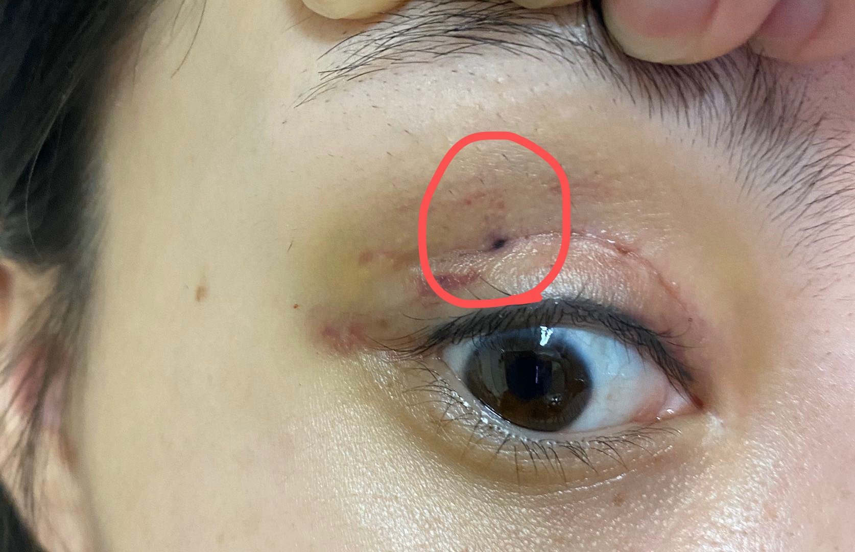 双眼皮拆线完皮下有一个黑点是什么 新氧 专业医美服务平台