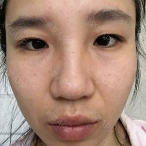 照片上看,轻微眼窝凹陷和眼袋,两眼间距近,有些大小眼,内双无神,建议