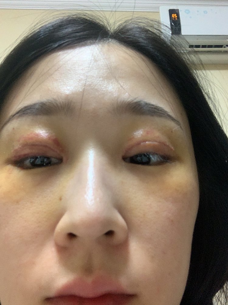 我的眼睛这是肿的还是自体脂肪眼部填充多了呢手术第五天刚拆线而且