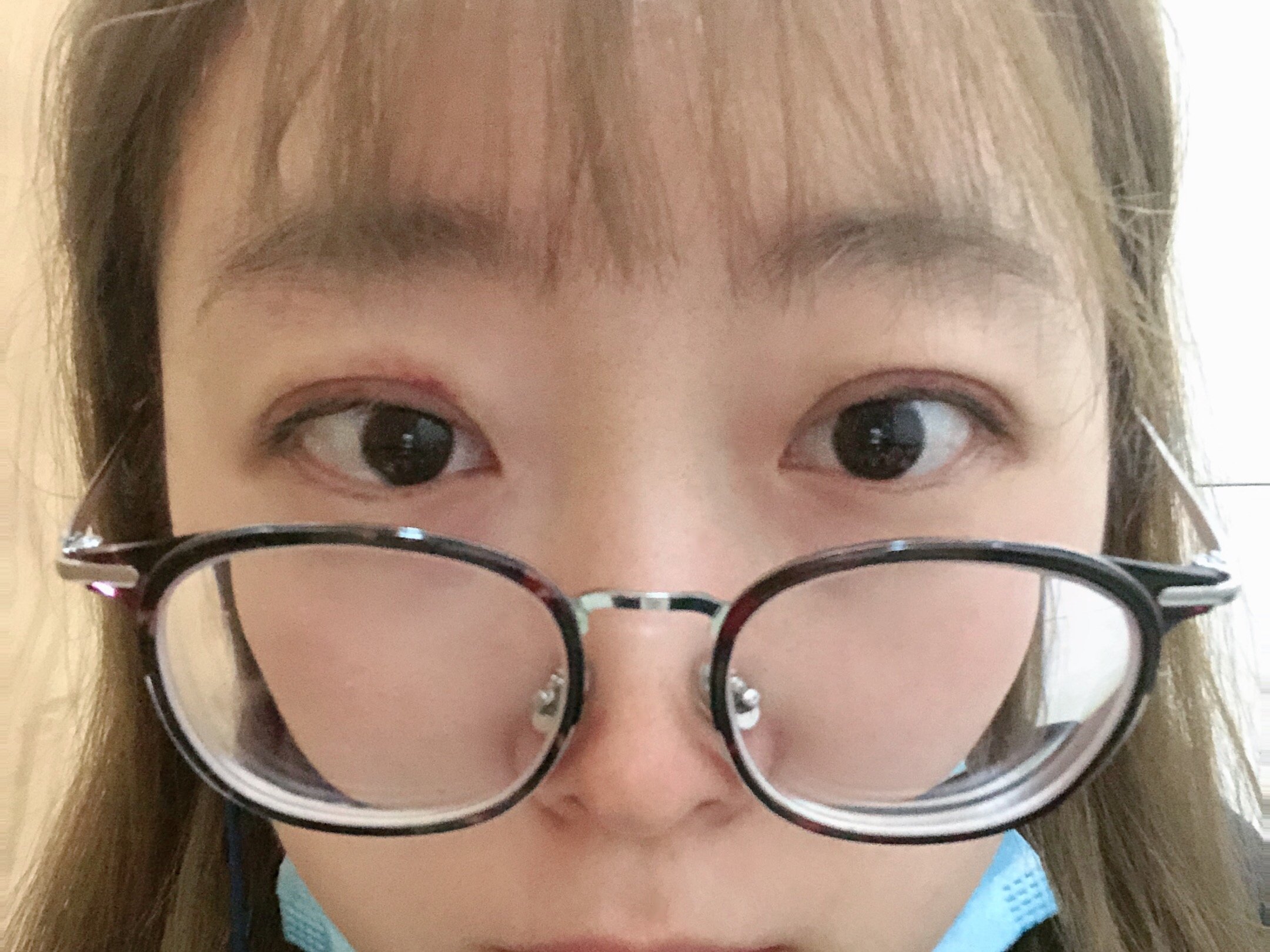 埋线双眼皮十天这样是不是失败了