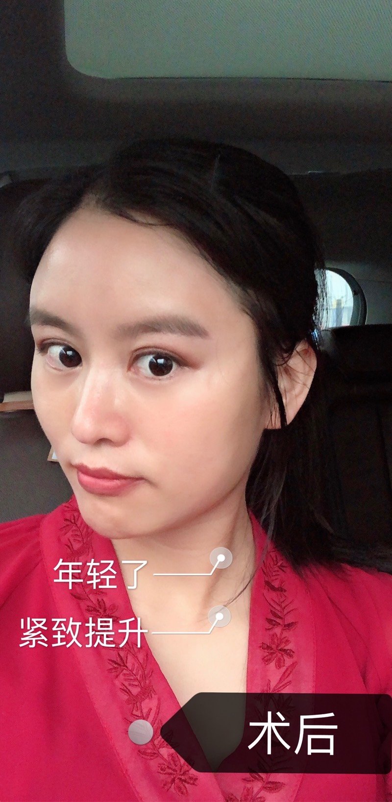 线雕后脸竟然变宽了该怎么办?