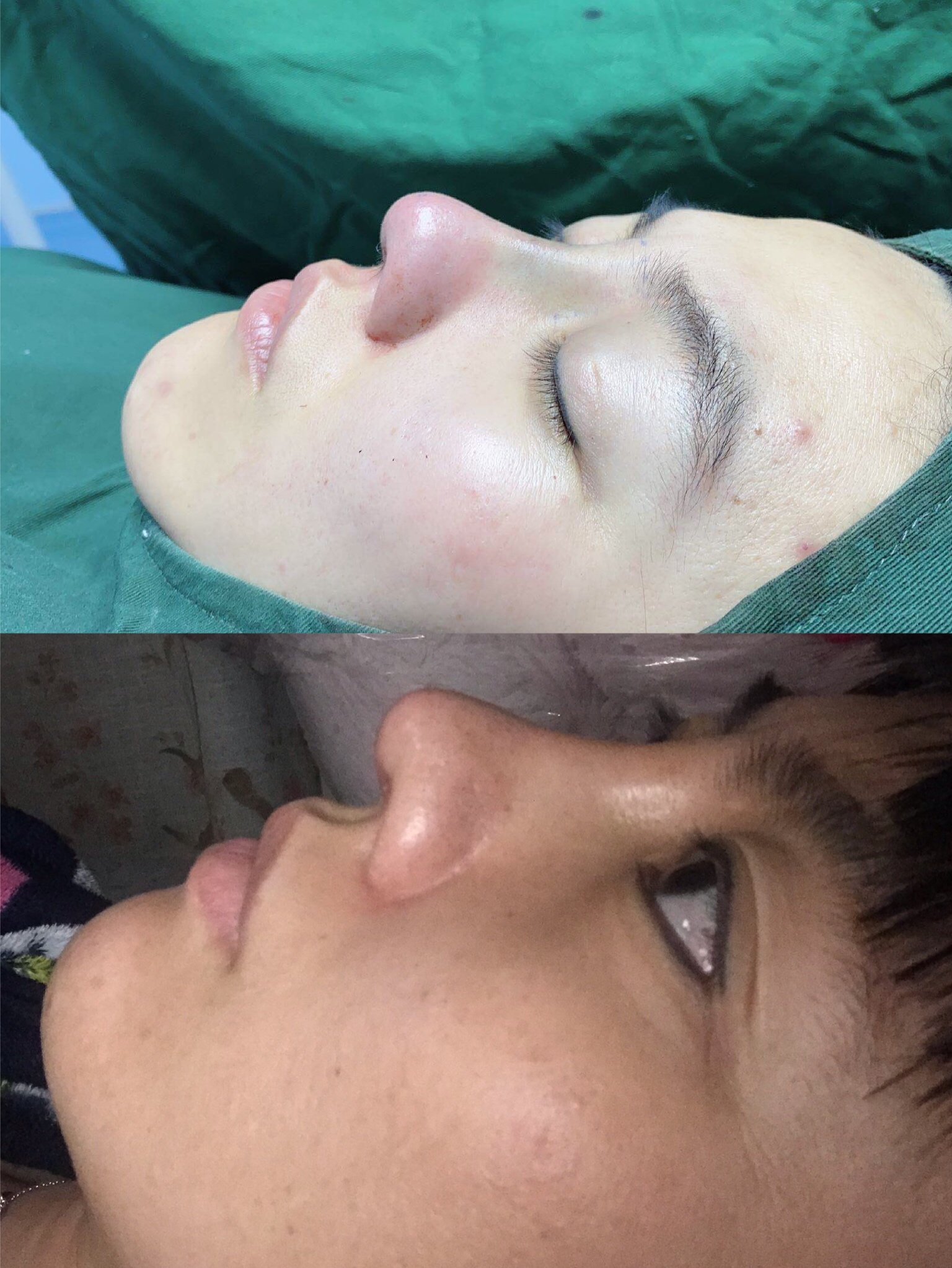 硅胶假体一个月,拆线后山根眉心位置就特别高,一直没_圈子-新氧美容