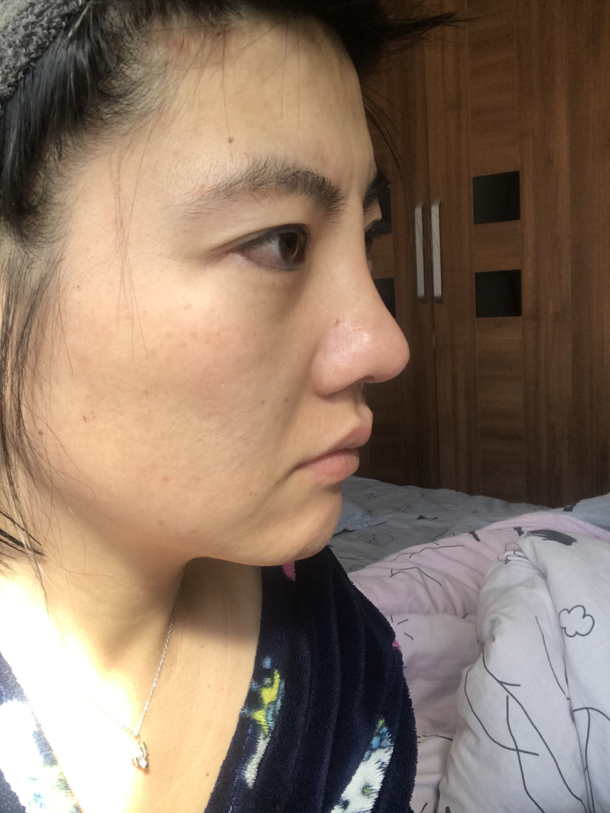 硅胶假体一个月,拆线后山根眉心位置就特别高,一直没_圈子-新氧美容